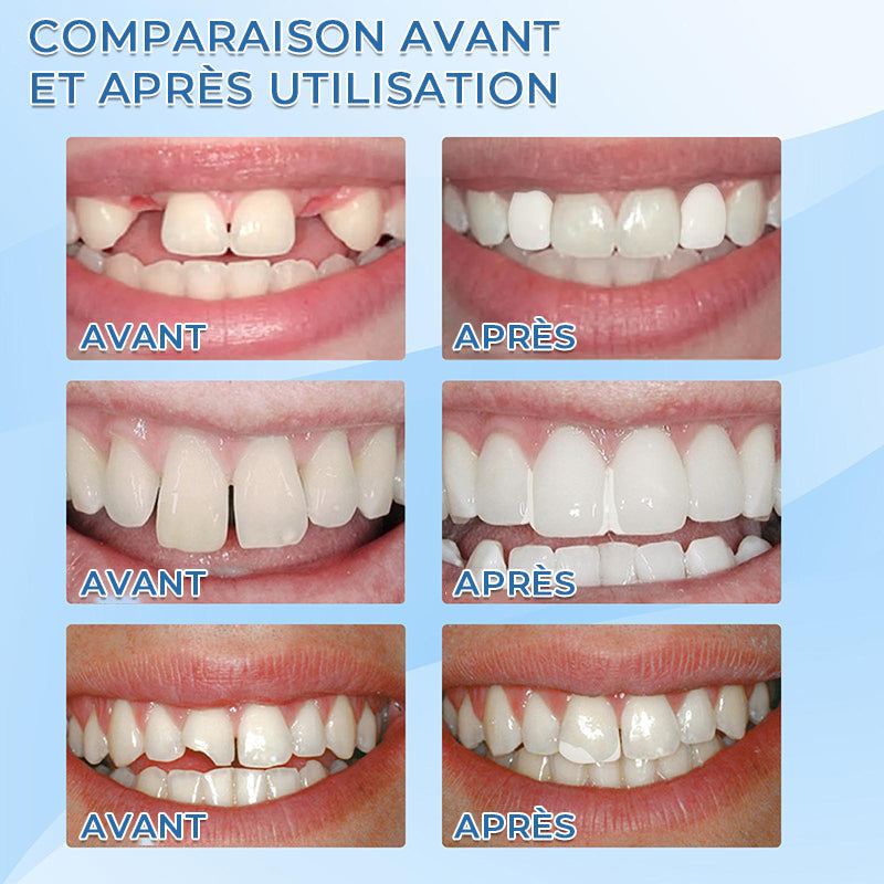 Adhésif pour restauration dentaire fixe